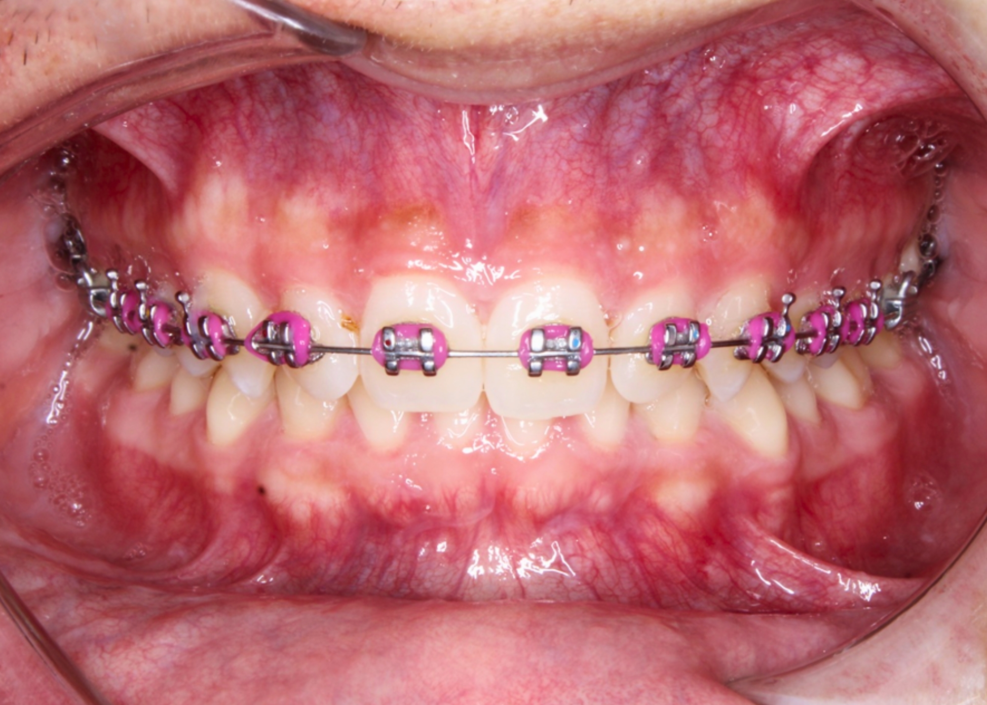 Brackets Convencionales
